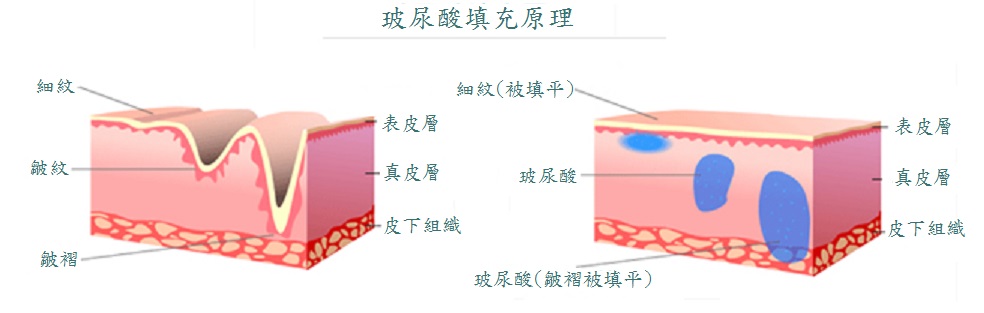 玻尿酸3